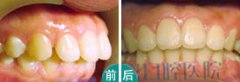 雙頜前突（齙牙）矯正案例