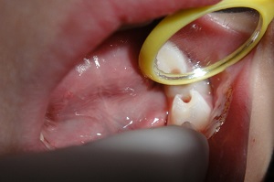 補(bǔ)牙之后需要注意些什么