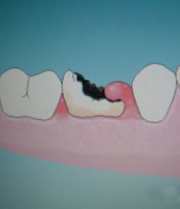 如何檢查小孩蛀牙