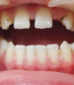 多生牙讓小孩哭鬧