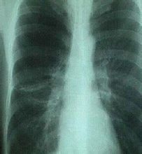 呼吸系統(tǒng)疾病